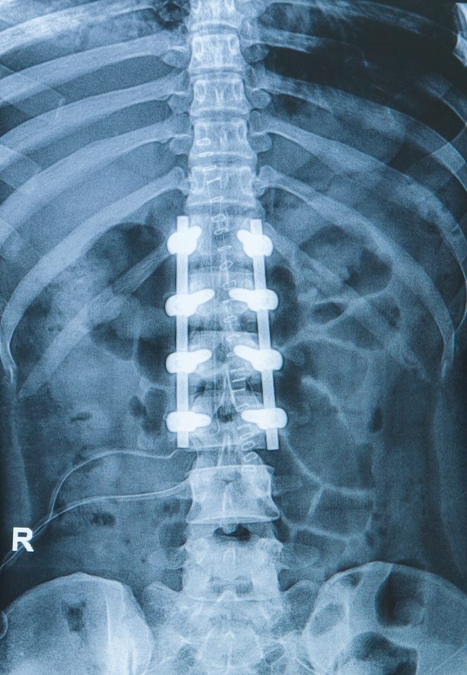 x-ray image of back pain show spinal column with implant, screw placement and fusion