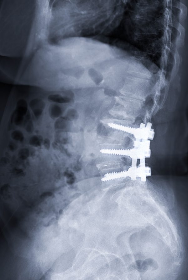 X-ray image of Lumbar spine showing pedicle screw fixation and decompression surgery in patient with spinal canal stenosis.